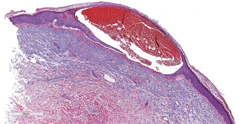 Hemorrhagic Papular Eruption On The Dorsal Hands Mdedge Dermatology