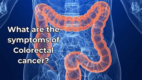 Colon cancer is the third most common cancer in men and women in the u.s. What are the symptoms of Colorectal cancer? - YouTube