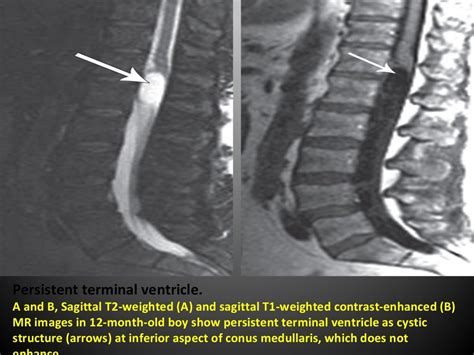 Radiological Findings Of Congenital Anomalies Of The Spine And Spinal