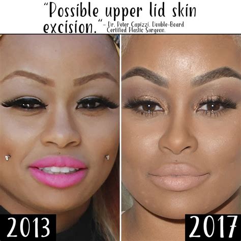 Black China Before After Plastic Surgery