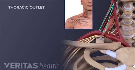 Neck Pain From Thoracic Outlet Syndrome