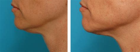 Double Chin Liposuction Cost Recovery Results