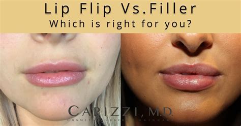 Lip Flip Botox Before And After Photos Infoupdate Org