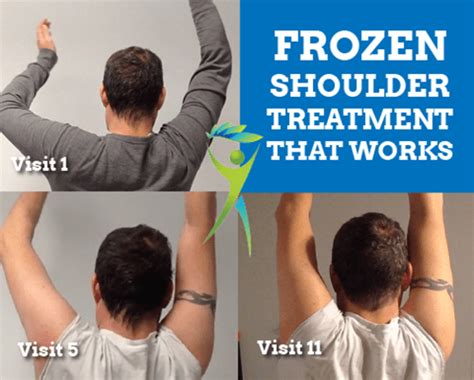Frozen Shoulder Treatment That Works Video Case Study