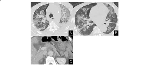 Ct Scan Showed Severe Bilateral Pulmonary Edema Small Amount Of