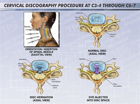 Cervical Discography Procedure At C3 4 Through C6 7 Order