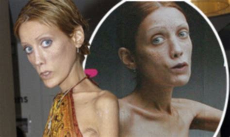 Anorexic Model Isabelle Caro Who Appeared In Shock Fashion Campaign Dies At 28 R News