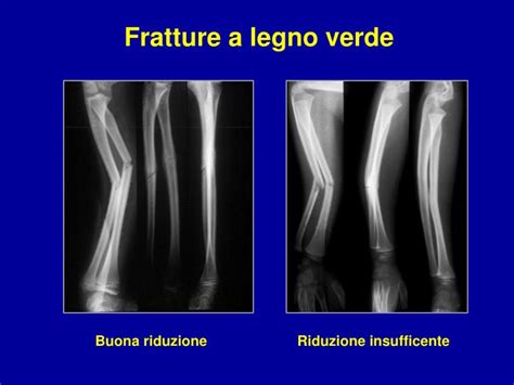 PPT - Fratture nei bambini PowerPoint Presentation - ID ...