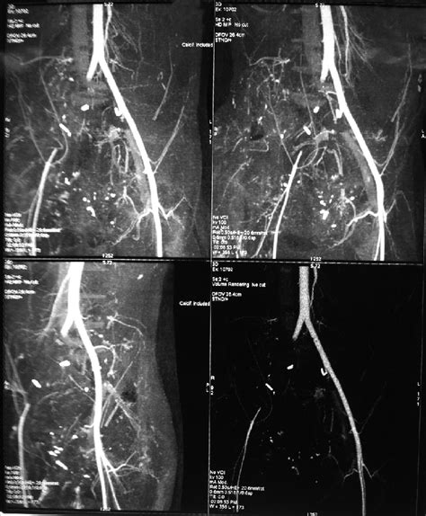 Ct Angiography Showing Thrombosis Of Right Common Iliac Artery And