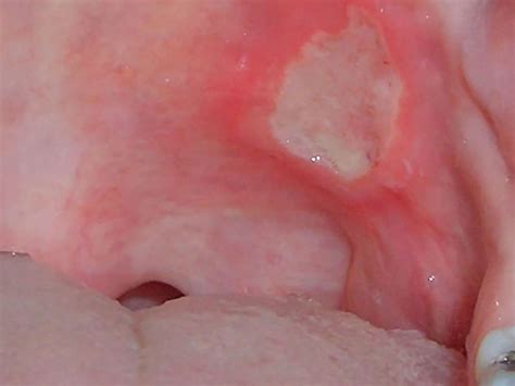 Mouth Ulcers On Tongue