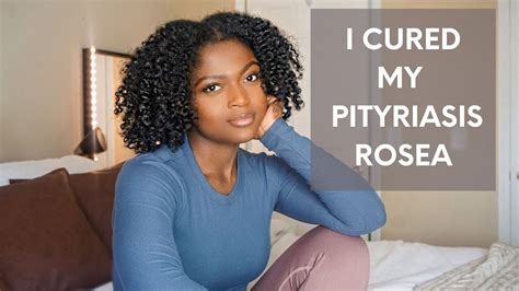 How To Cure Pityriasis Rosea Get Rid Of Pityriasis For Good Story