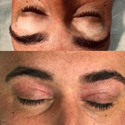 Vitiligo - Plastic Surgery Scars Camouflage | Cosmetic ...