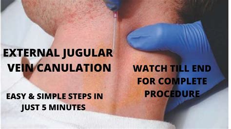 External Jugular Vein Cannulation Procedure With Simplified Steps Youtube