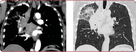 Unilateral Pulmonary Hilar Tumor Mass Is It Always Lung Cancer Pdf