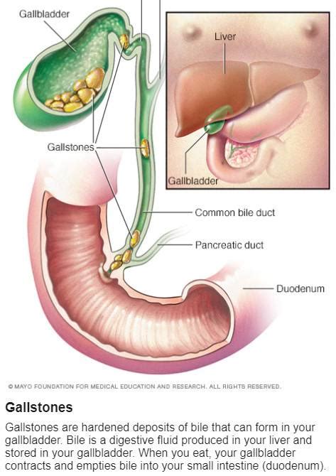 Gallbladder And Gallstone Symptoms Remove Gallstones Without Surgery Hot Sex Picture