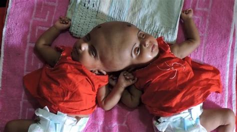 Conjoined Twins Facing Early Death To Undergo Surgery To Seperate Their
