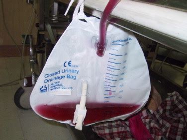 Purple urine bag syndrome (pubs) is an uncommon condition that occurs in urinary catheterized patients with urinary tract infection (uti). Purple urine bag syndrome in a dead-on-arrival patient ...