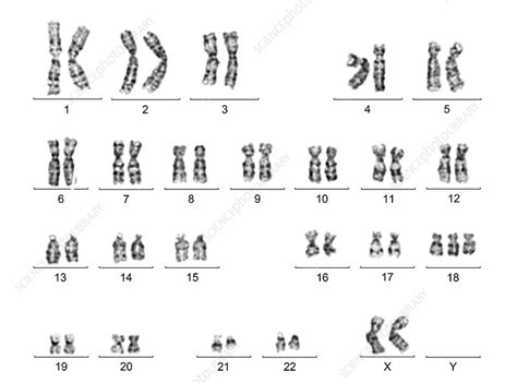 Female Karyotype With Trisomy 18 Stock Image C0166738 Science