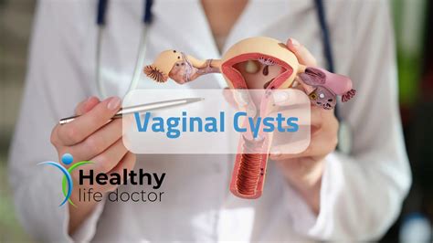 Vaginal Cysts The Best Way To Diagnose And Treat