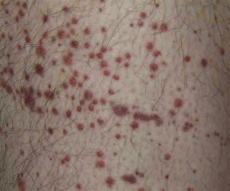 Rash Decisions An Approach To Dangerous Rashes Based On Morphology