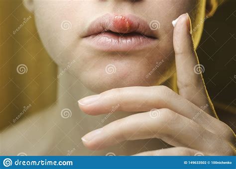 Worldwide this virus is from 65 to 90 percent of people. Beautiful Woman Applying Ointment On Her Upper Lip With Herpes. Stock Photo - Image of crusted ...