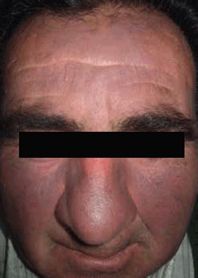 Racgp Facial Discolouration A Case Study