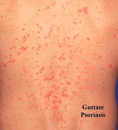 The Best Guttate Psoriasis Treatment Options And 7 Tips To Prevent