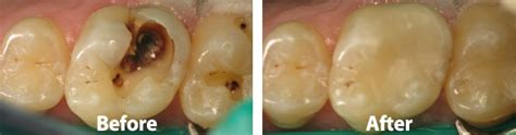 White Fillings Austin Dentist Replace Gray Amalgam Fillings