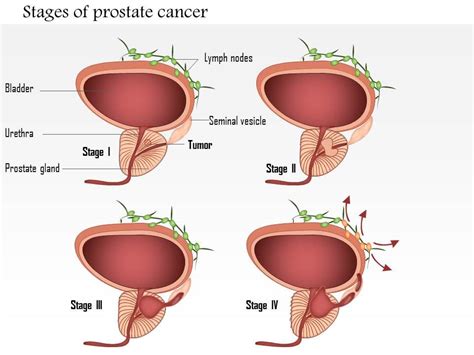 Stages Of Prostate Cancer Medical Images For Powerpoint Powerpoint Templates Download
