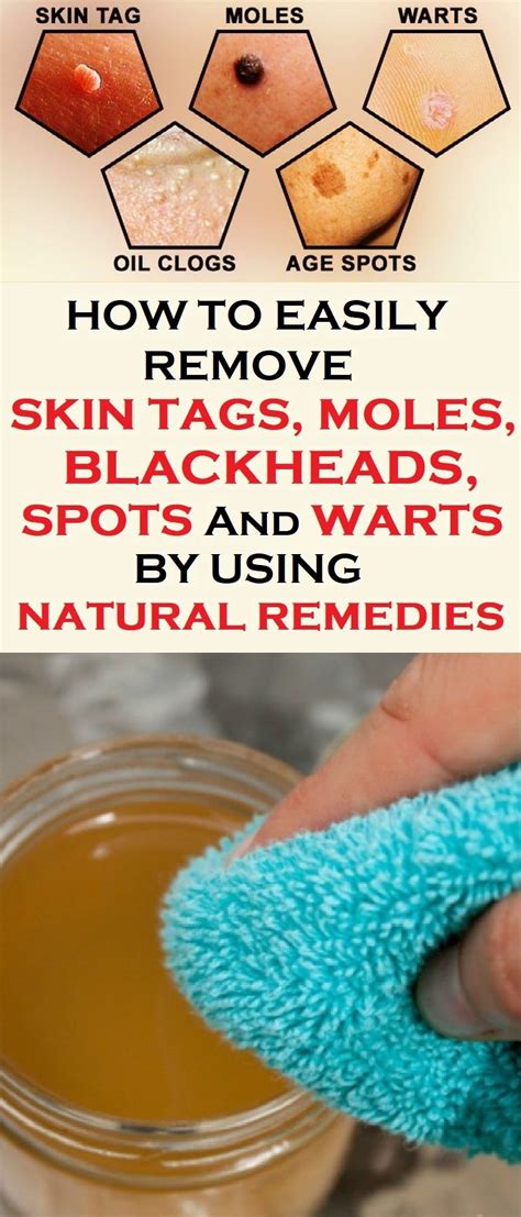 how to easily remove skin tags moles blackheads spots and warts by using natural remedies