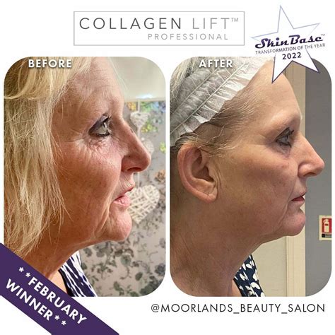 Collagen Lift Before And After Images