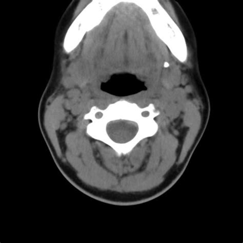 Submandibular Duct Stone Radiology Case