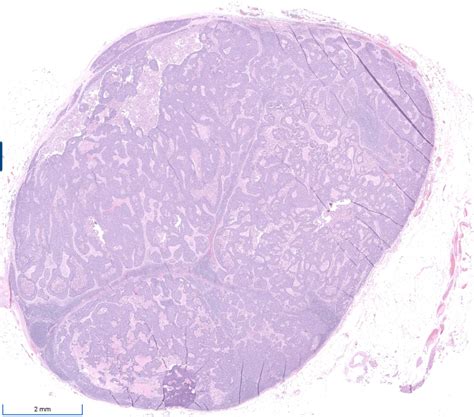 Week 789 Case 1 Johns Hopkins Surgical Pathology Unknown Conference