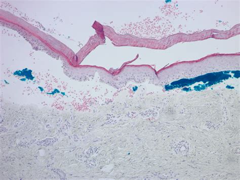 Biopsy Of Bullous Lesion Demonstrating Cell Poor Sub‐epidermal