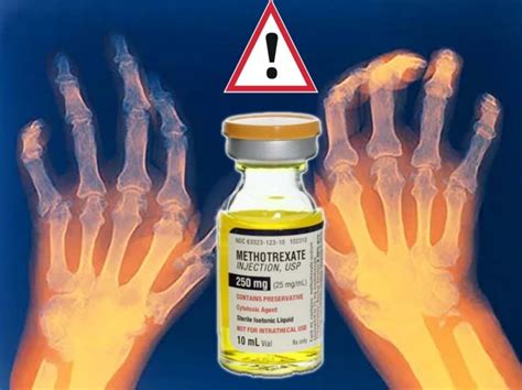 Rheumatoid Arthritis Drug Methotrexate May Elevate A Risk Of A