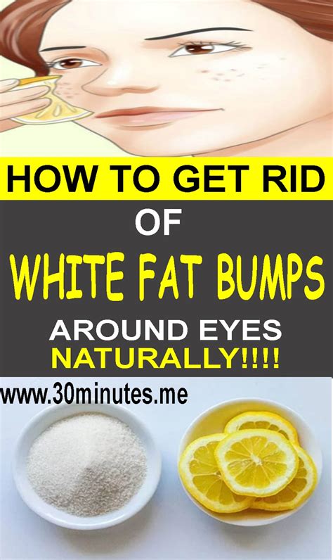 How To Get Rid Of White Fat Bumps Around Eyes Naturally Health And