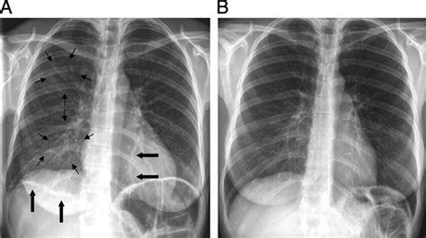 A Chest X Ray On Admission Few Ground Glass Opacities In The Right