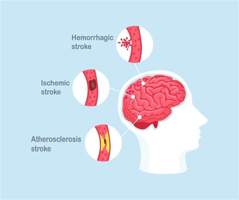 Types Of Human Brain Stroke Ischemic Atherosclerosis And Hemorrhagic Stroke Disease 10200109