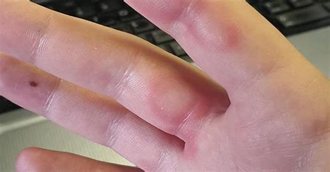 bumps on fingers after fevers imgur