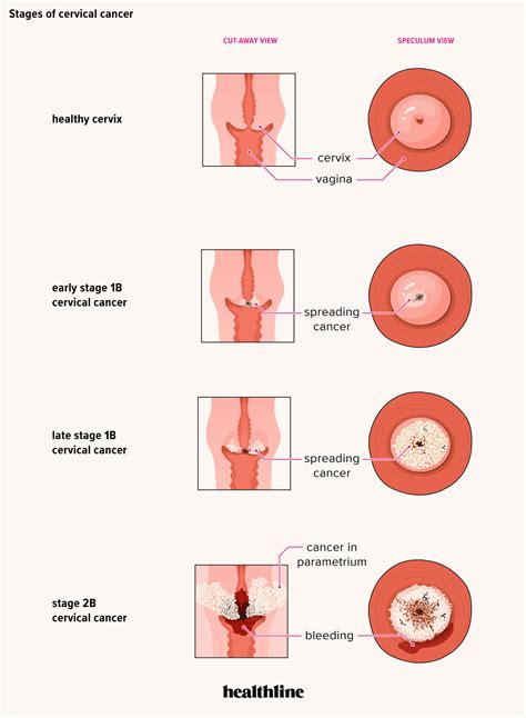 Early cervical cancer may not cause noticeable signs or symptoms. Cervical cancer early signs and symptoms - Pin on All ...