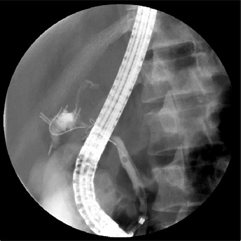 Ercp With Contrast Extravasation From Distal Common Bile Duct Note