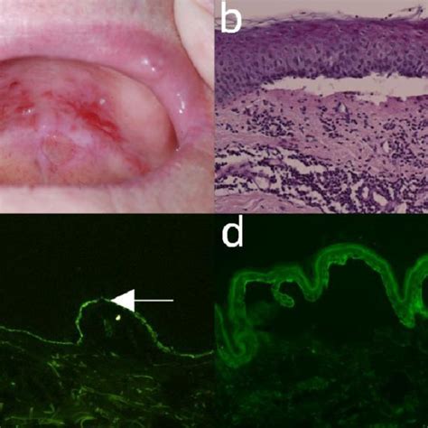 Mucous Membrane Pemphigoid A Buccal Erosions In A 77 Year Old Female