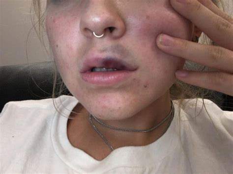Is It Normal To Bruise After Lip Fillers