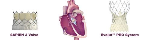 Transcatheter Aortic Valve Replacement Tavr Catholic Medical Center