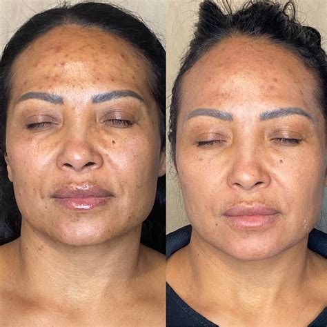 Before And After Facial Treatment Results For Acne Acne Scars Anti Aging Wrinkles Sun Damage
