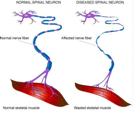 Als attacks cells in the brain and spinal cord that are needed to keep muscles moving, leading to muscle weakness and paralysis. What are Muscle disorders
