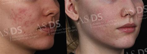 Laser Resurfacing For Acne Scars