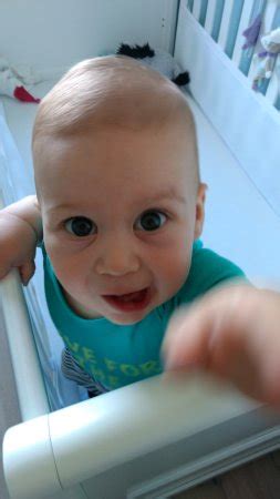 However, they may also be due to certain medical conditions, including: Epicanthic Fold Down Syndrome Vs Normal