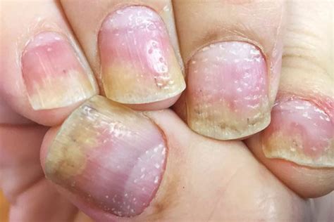 Among the medications that can cause hair loss are: Eight important things your nails say about your health ...