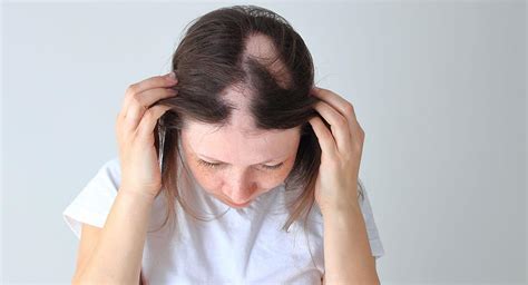 Alopecia Femenina ¿qué Es Causas Y Qué Tipos Hay